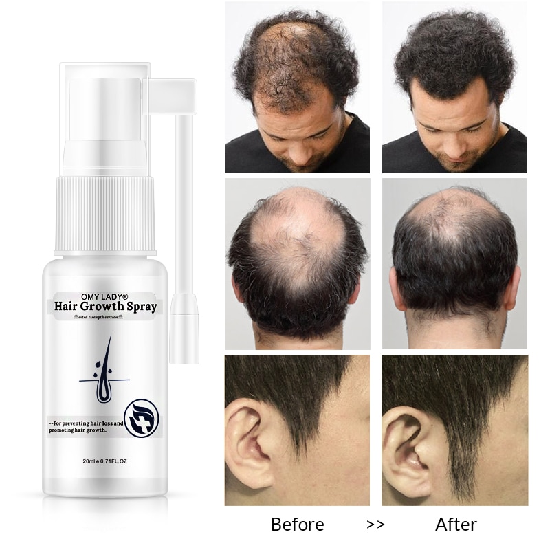 OMY LADY Anti Hair Loss Hair Growth Spray Essential Oil Liquid For Men ...