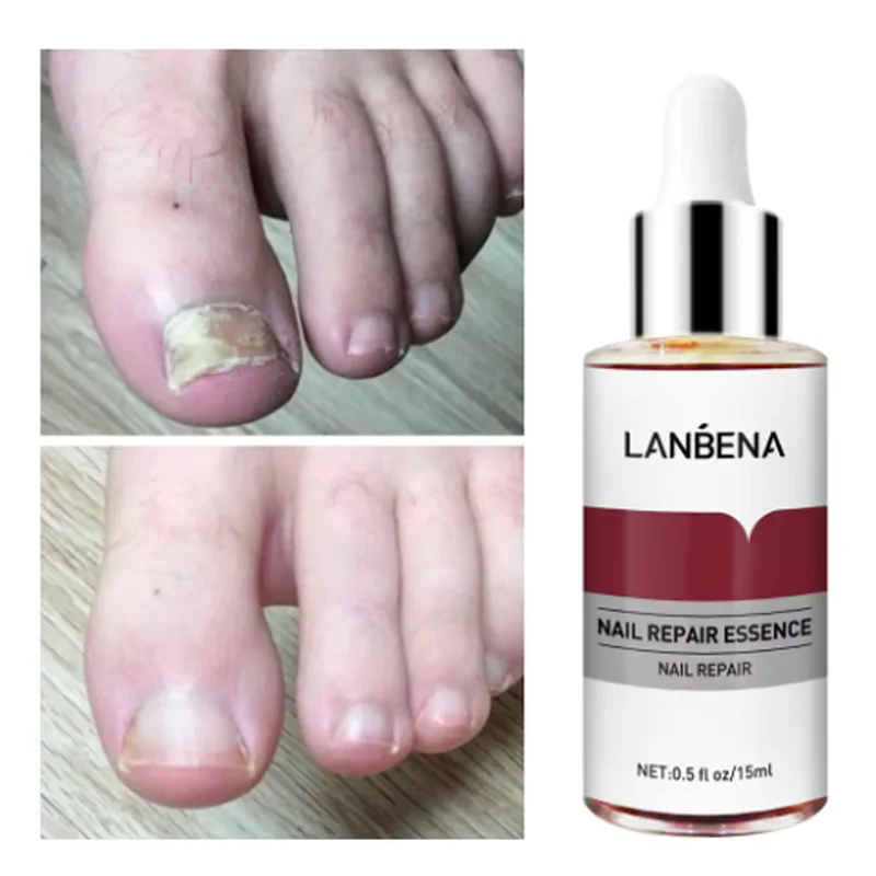 LANBENA Fungus Care Remove Onychomycosis Toes Nourish Brighten Hands Feet Product Repair Suitable Women Nail Pepair Essencs