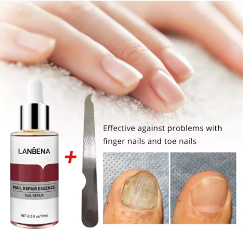 LANBENA Fungus Care Remove Onychomycosis Toes Nourish Brighten Hands Feet Product Repair Suitable Women Nail Pepair Essencs