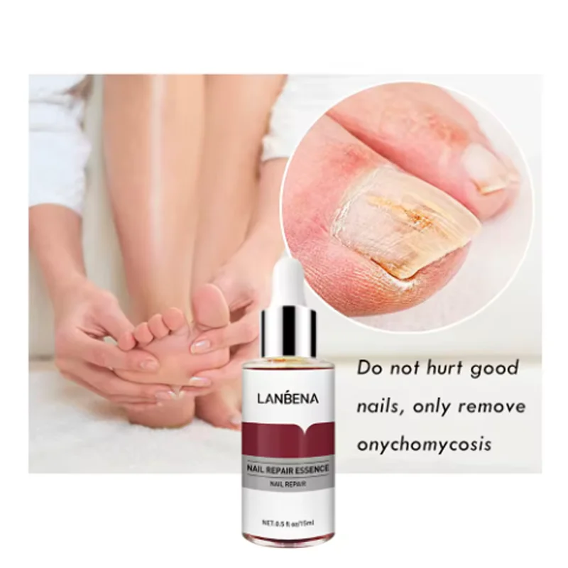 LANBENA Fungus Care Remove Onychomycosis Toes Nourish Brighten Hands Feet Product Repair Suitable Women Nail Pepair Essencs