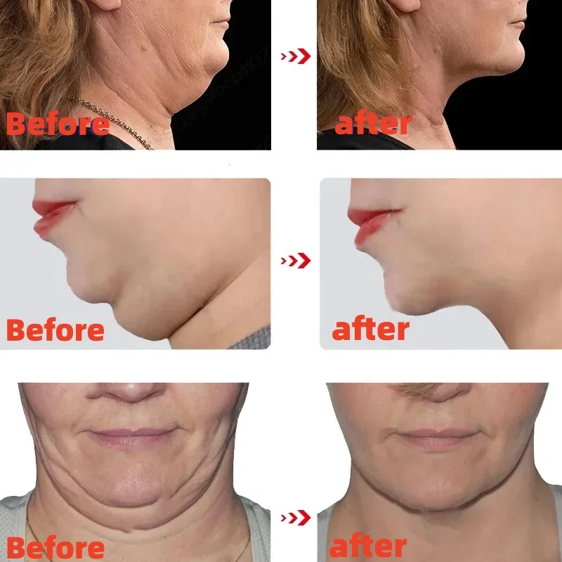 V Shape Slimming Cream Firming Face-lift Remove Masseter Muscle Double Chin Tighten Mandibular Fat Burning Cream Fade Neck Lines