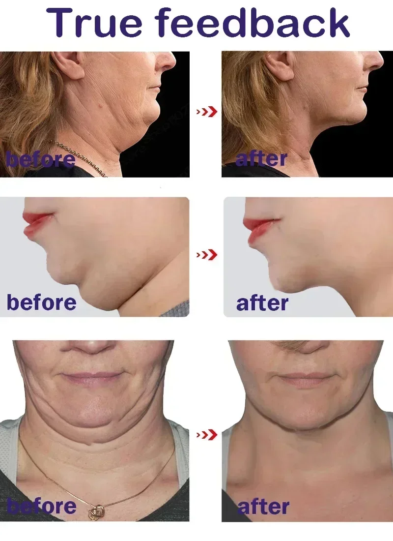 V-Shape Firming Face-lift Slimming Cream Removal Masseter Muscle Double Chin Face Fat Burning Anti-aging Products